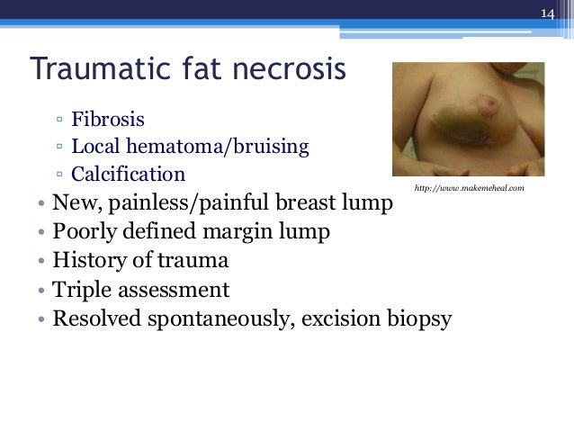 cysts in breast from trauma Culley cindy porn